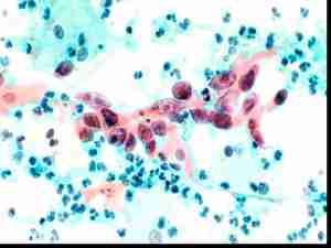 Evaluar el rendimiento de un microscopio conectable de teléfono móvil de bajo costo en citología cervical